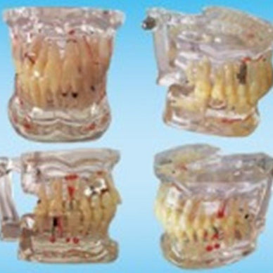 Implant Pathology Model Teeth Models Patient Education Demonstration - eLynn Medical