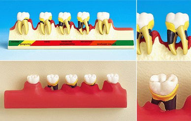 Dental Human Teeth Periodontal Disease Classification Model Patient Education - eLynn Medical