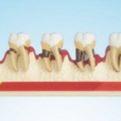 Dental Periodontal Diseases Classification Model TEETH Models Tooth Education - eLynn Medical