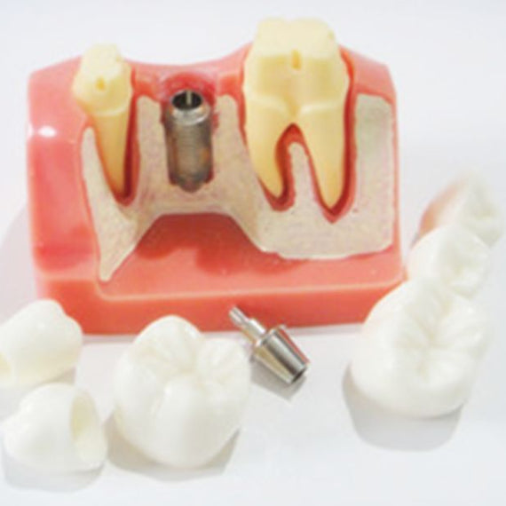 Dental Implant Crown Bridge Model Teeth Models Patient Education Demonstration - eLynn Medical