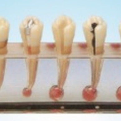 Dental Clinical Model of Tooth and Dental Pulp Disease A for root canal curing - eLynn Medical