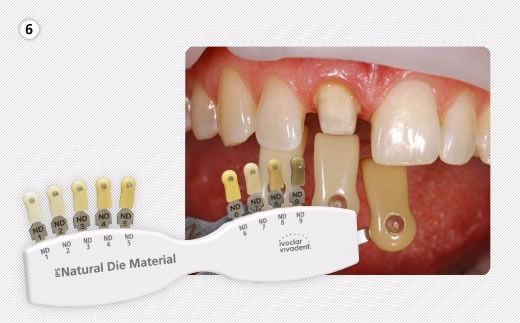 Stumpf Shade Guide IPS Natural Die Material Shade Guide - Ivoclar Vivadent – Elynn Medical