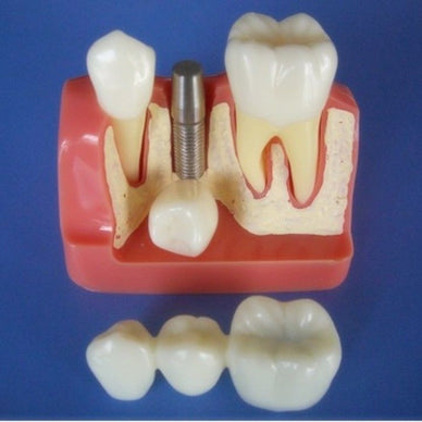 Implant Teeth Model 2.5x size for Dentist Patient Communication Education - eLynn Medical