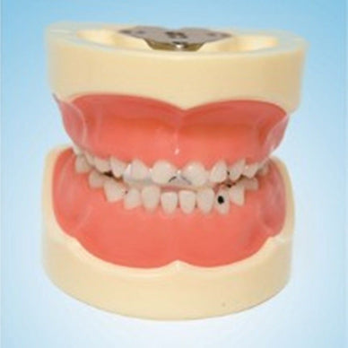 Dental Children Teeth Caries Gum removal of bad can High Quality Teeth Models - eLynn Medical